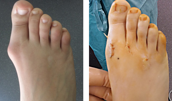 La chirurgie mini-invasive du pied et percutanée