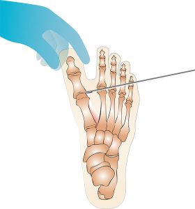 La chirurgie mini-invasive du pied et percutanée